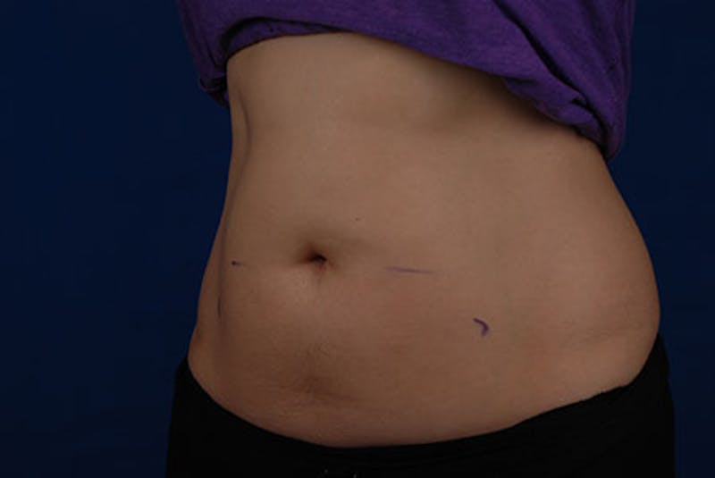Coolsculpting Before & After Gallery - Patient 12973855 - Image 3