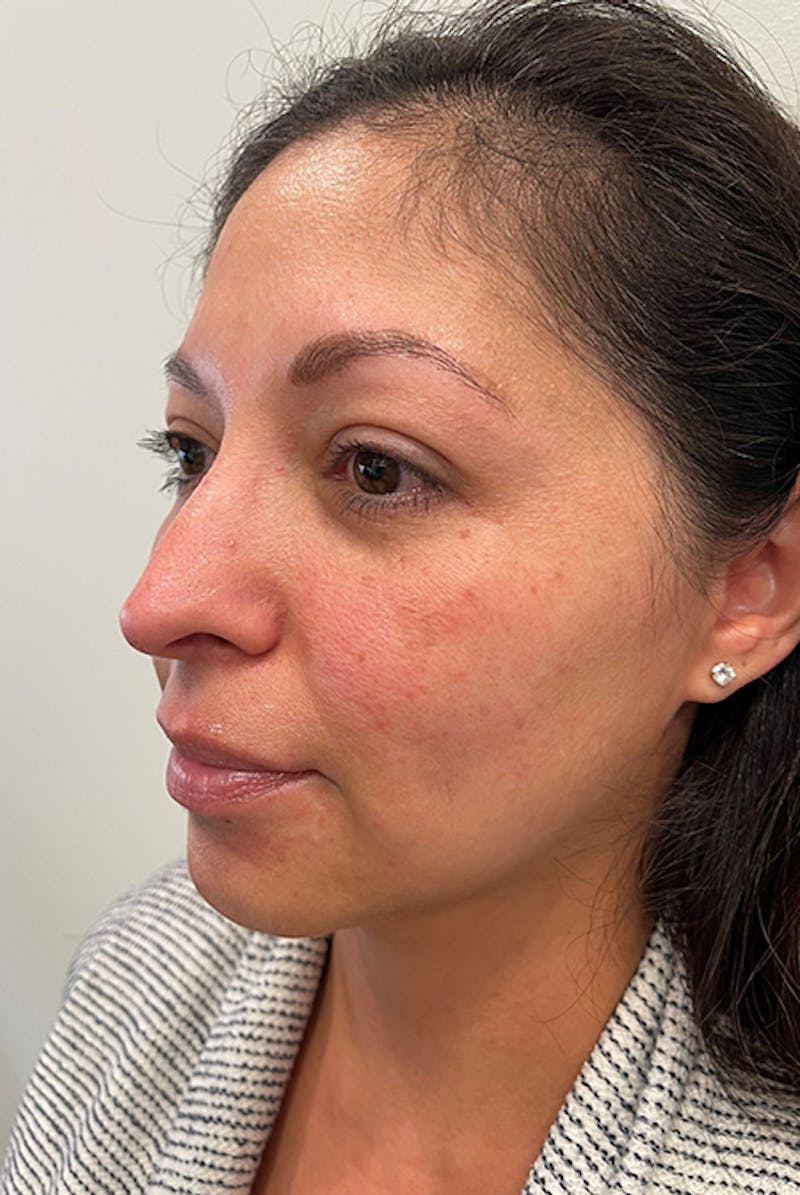 Full Face Before & After Gallery - Patient 12973865 - Image 3