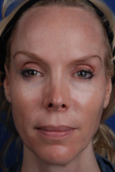 Sculptra Before & After Gallery - Patient 12973859 - Image 1