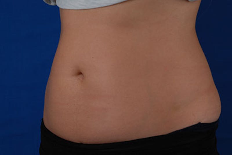 Coolsculpting Before & After Gallery - Patient 12973855 - Image 4