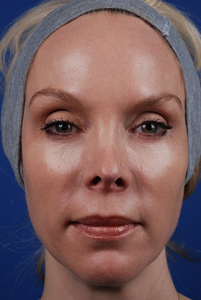 Sculptra Before & After Gallery - Patient 12973859 - Image 2