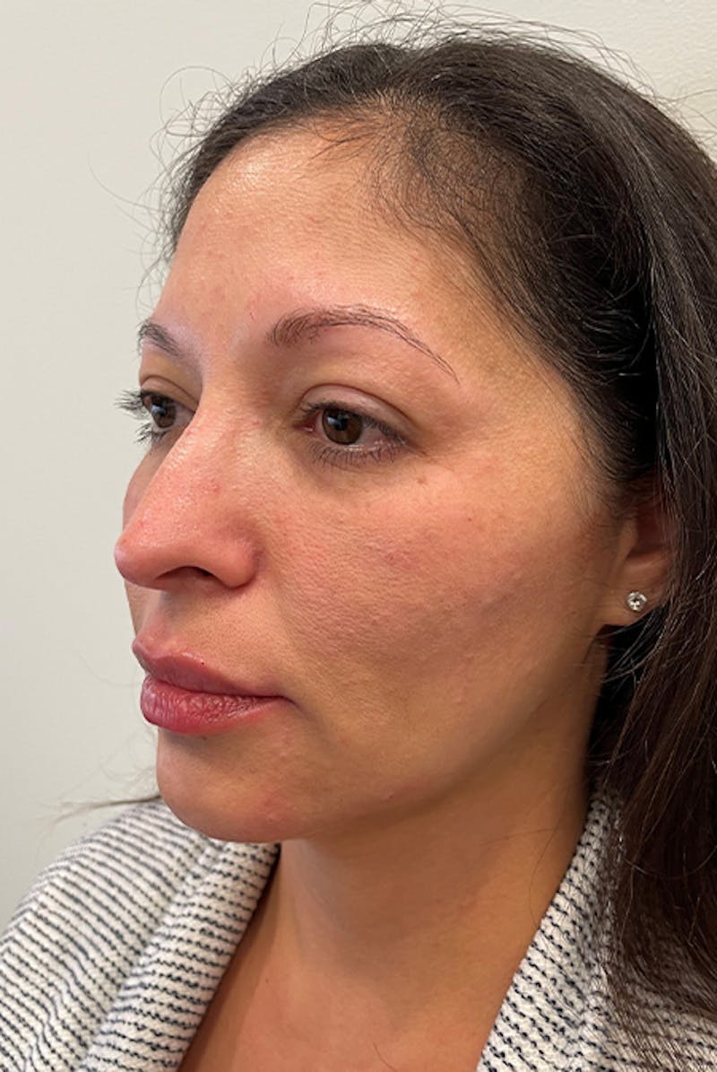 Full Face Before & After Gallery - Patient 12973865 - Image 4