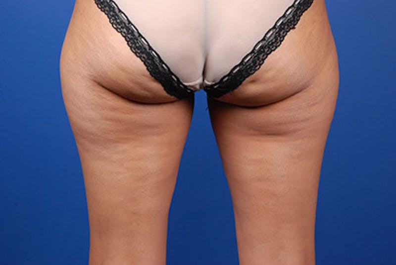 Coolsculpting Gallery - Patient 12973860 - Image 1