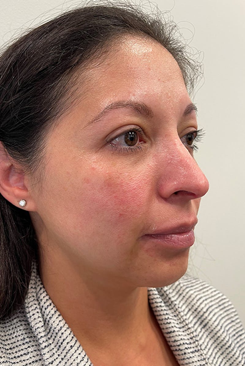 Full Face Before & After Gallery - Patient 12973865 - Image 5