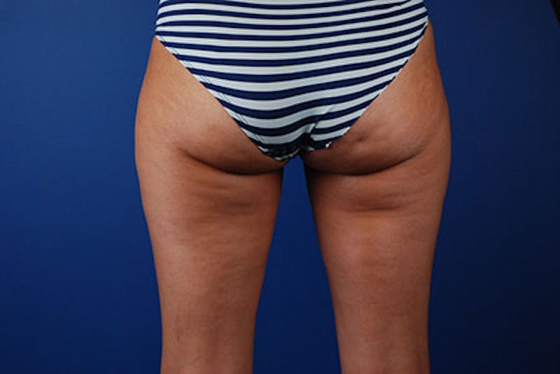 Coolsculpting Before & After Gallery - Patient 12973860 - Image 2