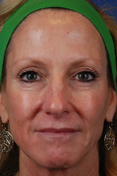 Sculptra Before & After Gallery - Patient 12973866 - Image 1