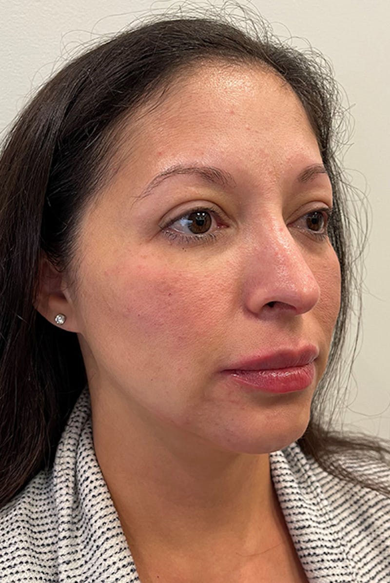 Full Face Before & After Gallery - Patient 12973865 - Image 6