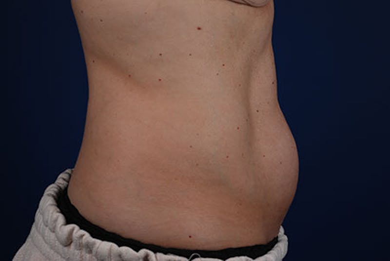 Coolsculpting Before & After Gallery - Patient 12973864 - Image 1