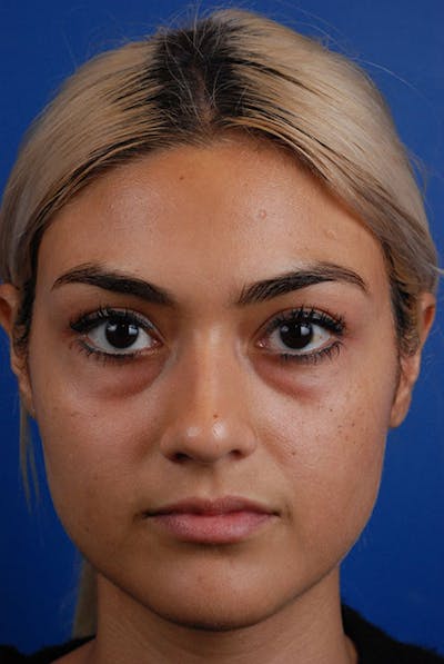 Tear Troughs Before & After Gallery - Patient 12973892 - Image 1