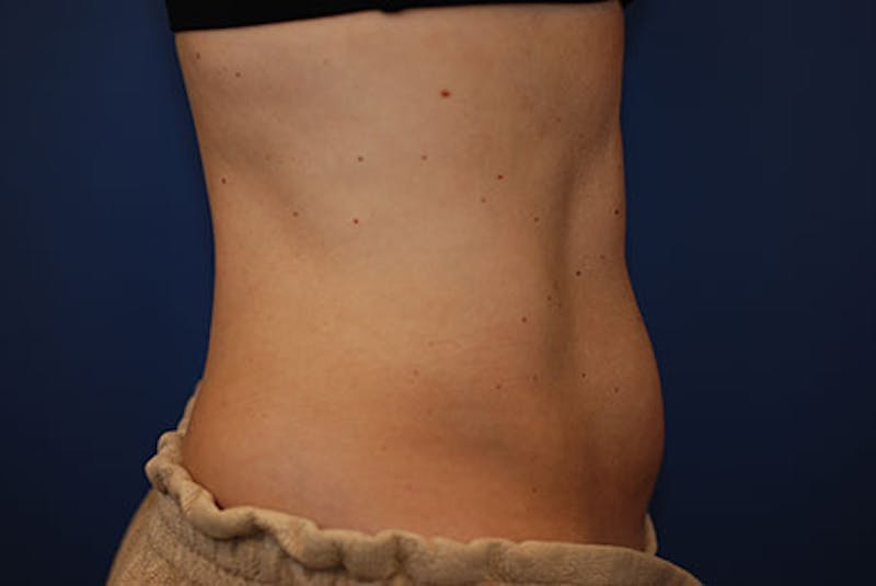 Coolsculpting Before & After Gallery - Patient 12973864 - Image 2