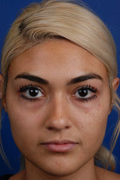 Tear Troughs Before & After Gallery - Patient 12973892 - Image 2