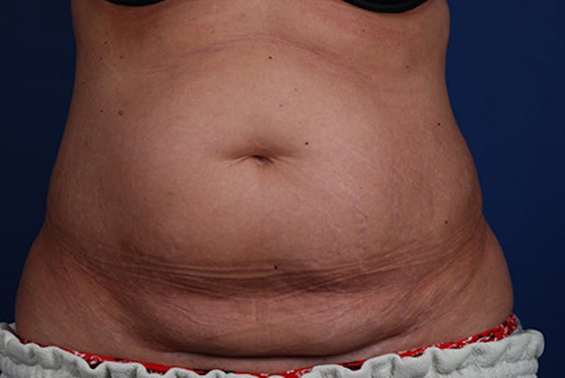 Coolsculpting Gallery - Patient 12973893 - Image 1
