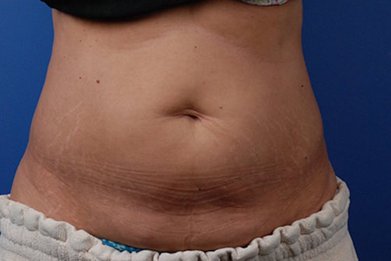 Coolsculpting Before & After Gallery - Patient 12973893 - Image 2