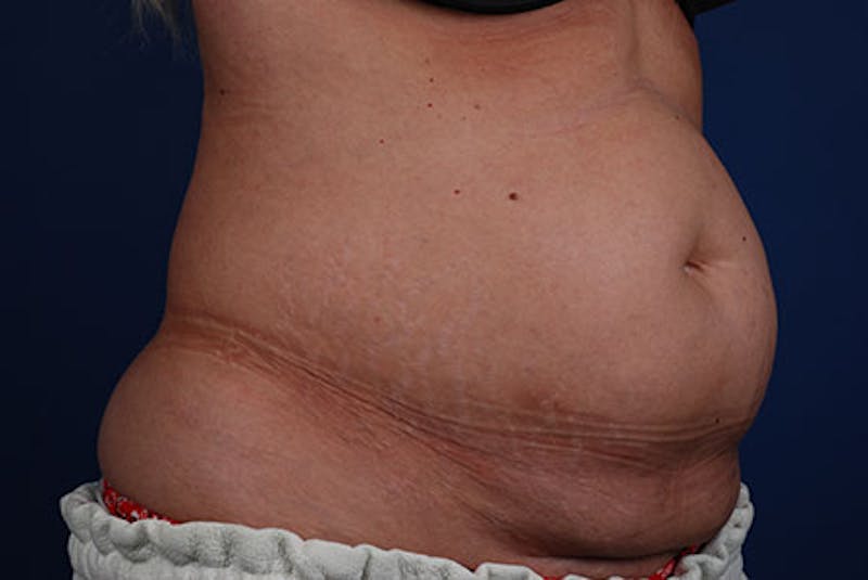 Coolsculpting Before & After Gallery - Patient 12973893 - Image 3