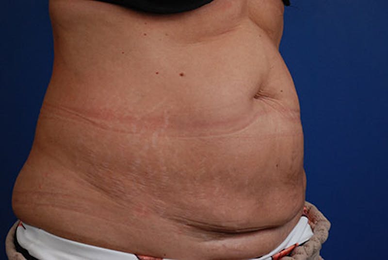 Coolsculpting Gallery - Patient 12973893 - Image 4