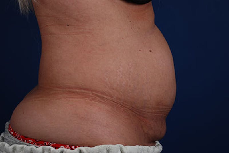 Coolsculpting Gallery - Patient 12973893 - Image 5