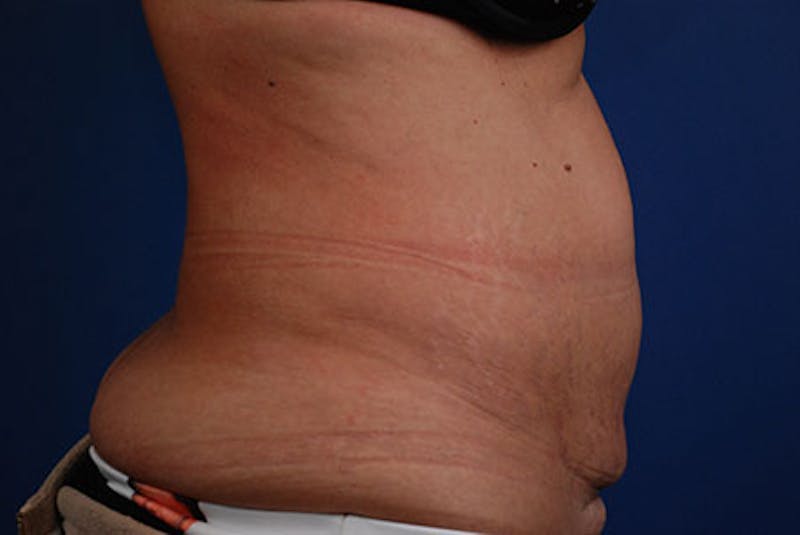 Coolsculpting Before & After Gallery - Patient 12973893 - Image 6