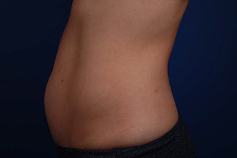Coolsculpting Before & After Gallery - Patient 12973898 - Image 1