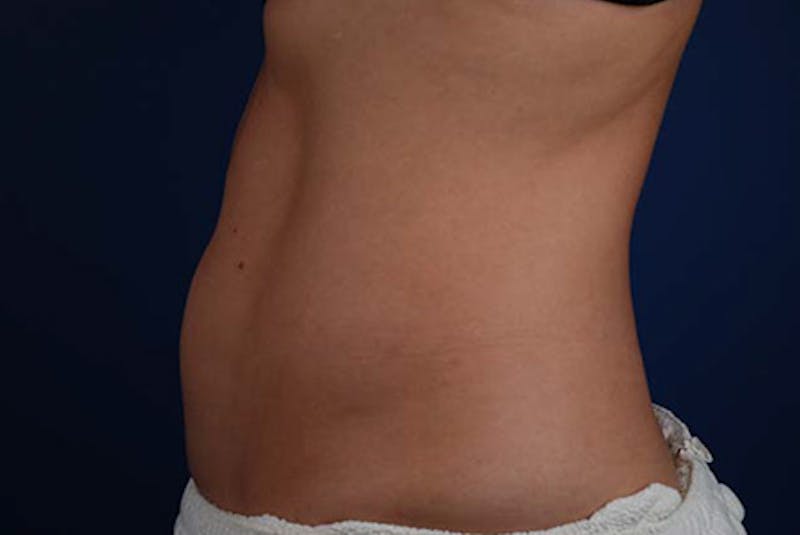 Coolsculpting Gallery - Patient 12973898 - Image 2