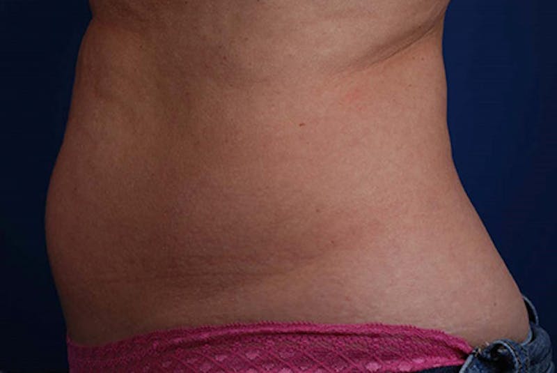 Coolsculpting Before & After Gallery - Patient 12973900 - Image 1