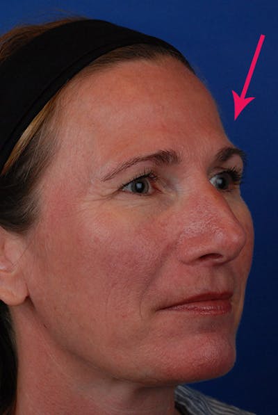 Forehead Filler Before & After Gallery - Patient 12973901 - Image 1