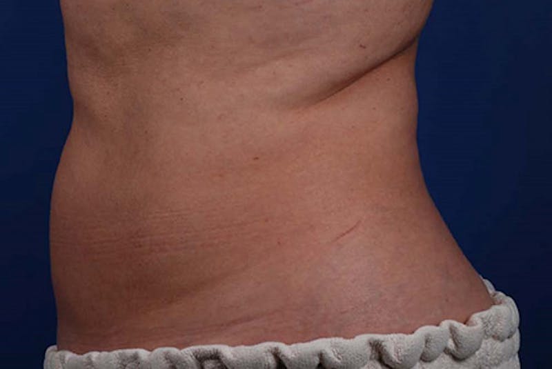 Coolsculpting Gallery - Patient 12973900 - Image 2