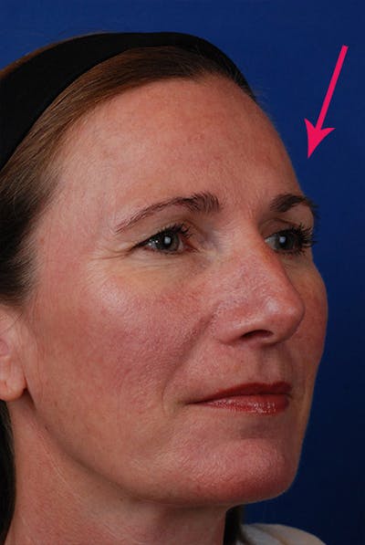 Forehead Filler Before & After Gallery - Patient 12973901 - Image 2