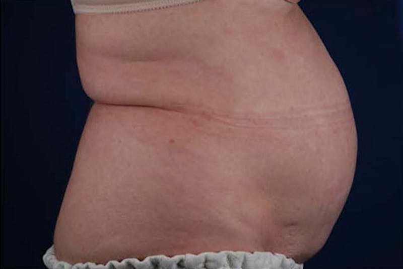 Coolsculpting Before & After Gallery - Patient 12973903 - Image 1