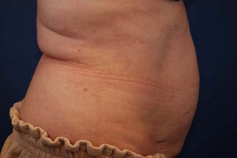 Coolsculpting Before & After Gallery - Patient 12973903 - Image 2