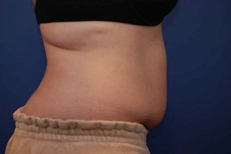 Coolsculpting Before & After Gallery - Patient 12973906 - Image 1