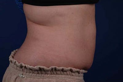 Coolsculpting Before & After Gallery - Patient 12973906 - Image 2
