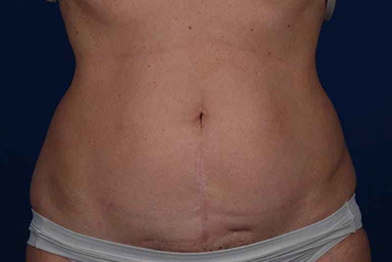 Coolsculpting Gallery - Patient 12973908 - Image 1