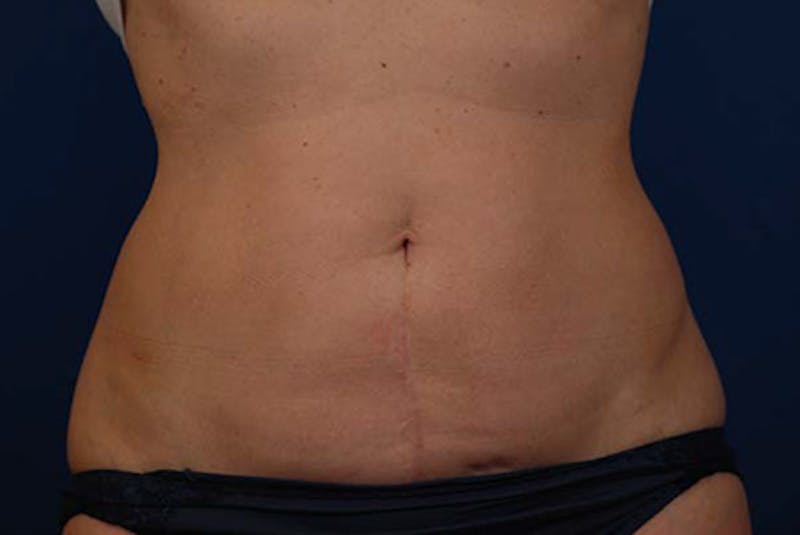 Coolsculpting Gallery - Patient 12973908 - Image 2