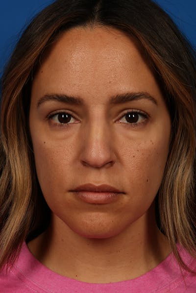 Nose Before & After Gallery - Patient 12973916 - Image 1