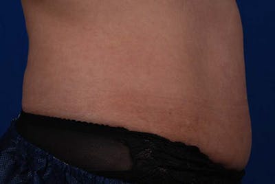 Coolsculpting Before & After Gallery - Patient 12973910 - Image 1