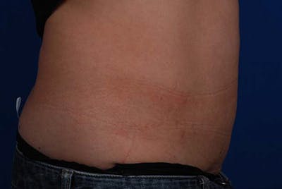 Coolsculpting Before & After Gallery - Patient 12973910 - Image 2