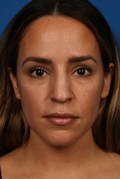 Nose Before & After Gallery - Patient 12973916 - Image 2