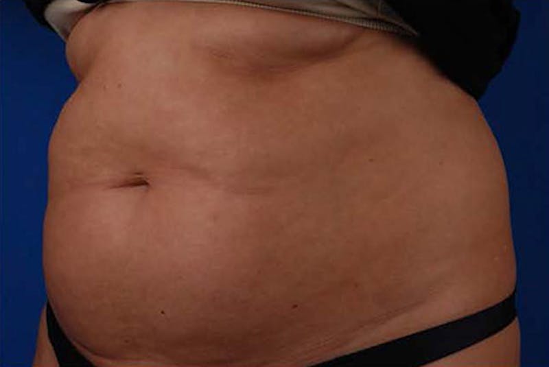 Coolsculpting Before & After Gallery - Patient 12973912 - Image 1