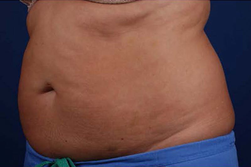 Coolsculpting Before & After Gallery - Patient 12973912 - Image 2