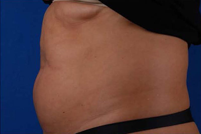 Coolsculpting Before & After Gallery - Patient 12973912 - Image 3