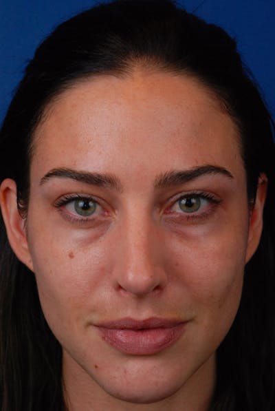 Tear Troughs Before & After Gallery - Patient 12973913 - Image 1