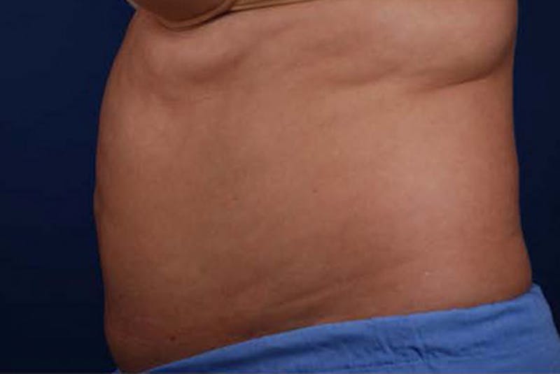 Coolsculpting Before & After Gallery - Patient 12973912 - Image 4