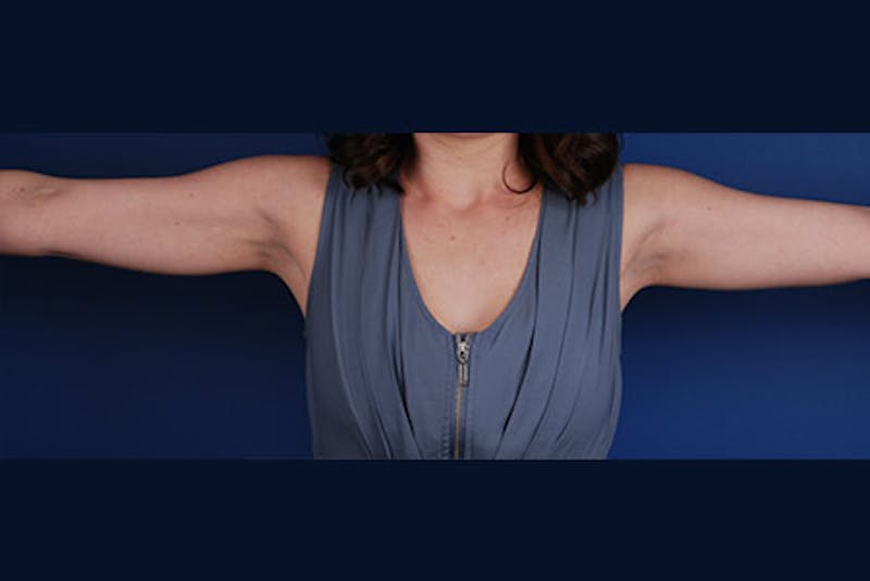 Coolsculpting Gallery - Patient 12973914 - Image 2