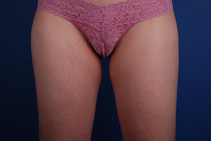 Coolsculpting Before & After Gallery - Patient 12973920 - Image 2