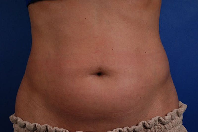 Coolsculpting Before & After Gallery - Patient 12973922 - Image 1