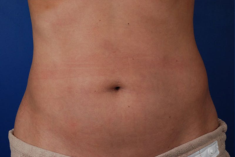 Coolsculpting Gallery - Patient 12973922 - Image 2