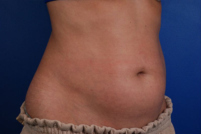 Coolsculpting Before & After Gallery - Patient 12973922 - Image 3