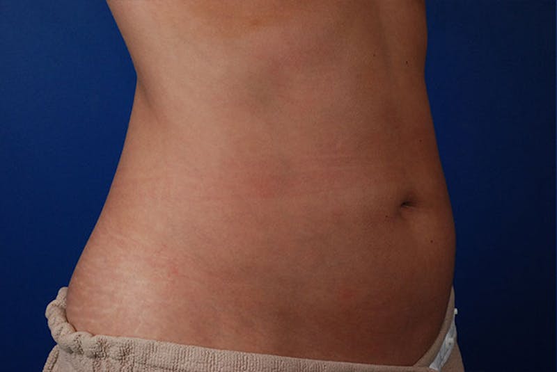 Coolsculpting Before & After Gallery - Patient 12973922 - Image 4
