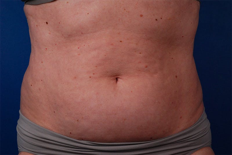 Coolsculpting Before & After Gallery - Patient 12973925 - Image 1