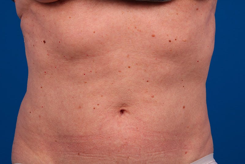 Coolsculpting Before & After Gallery - Patient 12973925 - Image 2